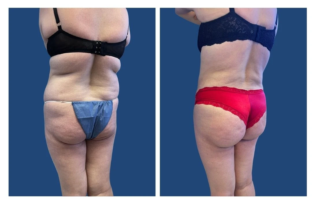 Liposuction of Back and Fat Grafting