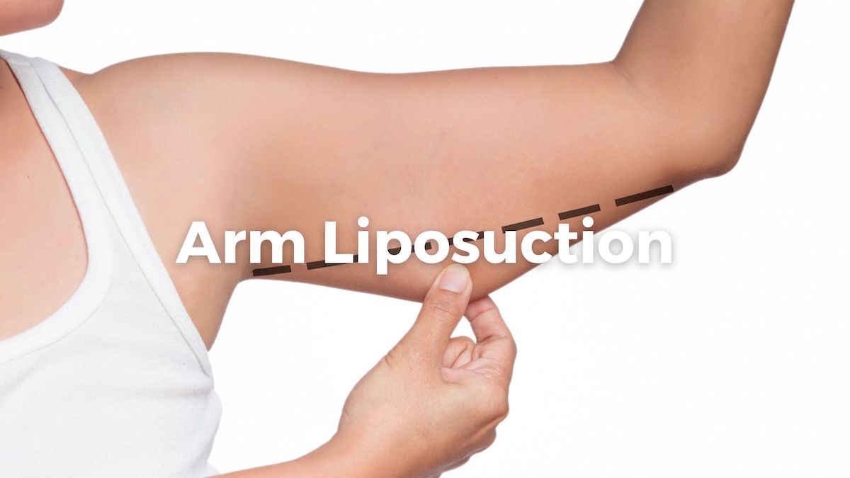 Unlocking the Potential of Arm Liposuction: Exercises, Procedures