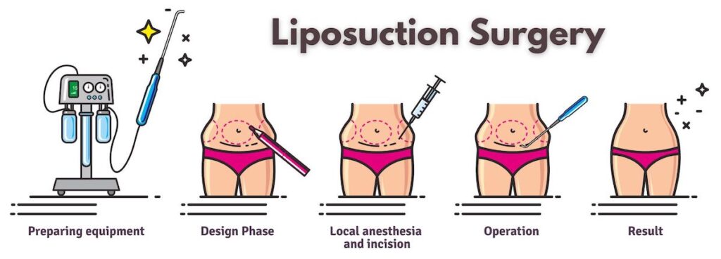 How To Liposuction Love Handles For Best Results