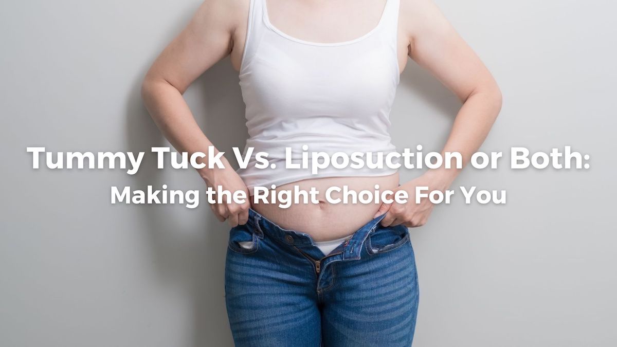 Tummy Tuck vs. Liposuction: Which to Choose?