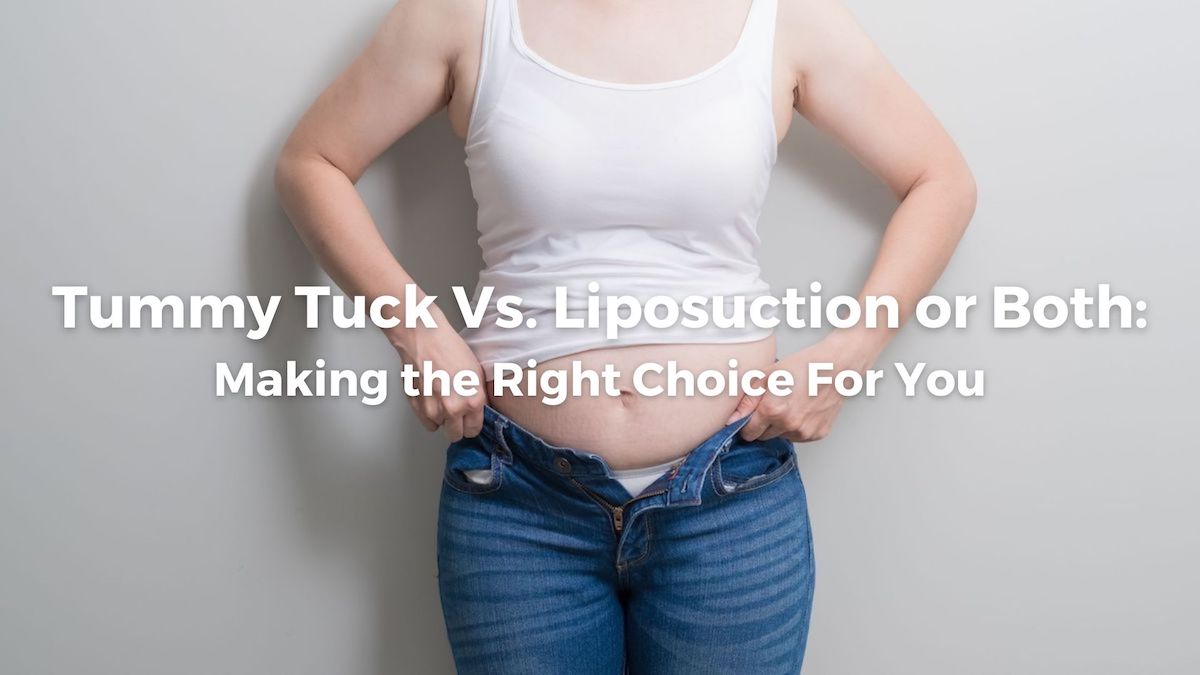 Tummy Tuck vs. Liposuction