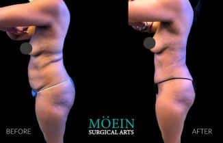 Side-by-side comparison of a person's torso before and after a surgical procedure, showing reduced abdominal volume.