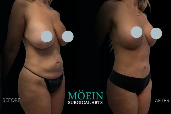 Tummy Tuck (Abdominoplasty) – Dennis