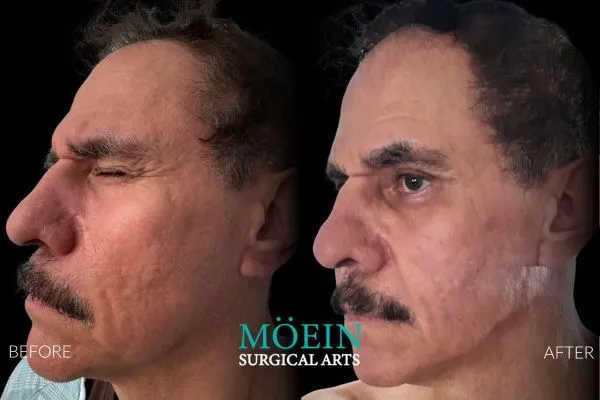 Co2 Laser Resurfacing