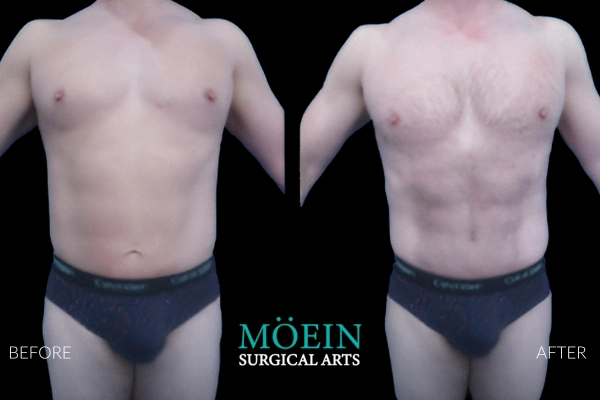 Abdominal Liposuction Results for men in Los Angeles