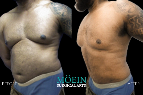 Abdominal Liposuction Results for men in Los Angeles