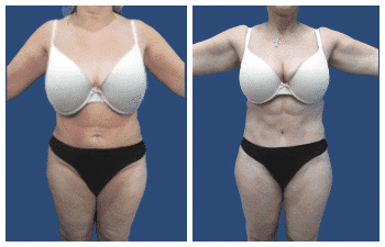 LA Cosmetic Surgeon: Tummy tuck before and after photos from a reputable LA cosmetic surgeon.