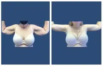 Two side-by-side images of a 3d rendering depicting a female figure before and after breast augmentation.