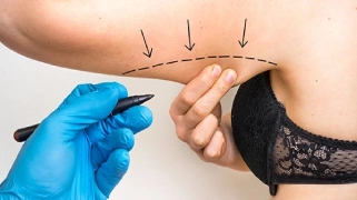 Arm Liposuction in LA
