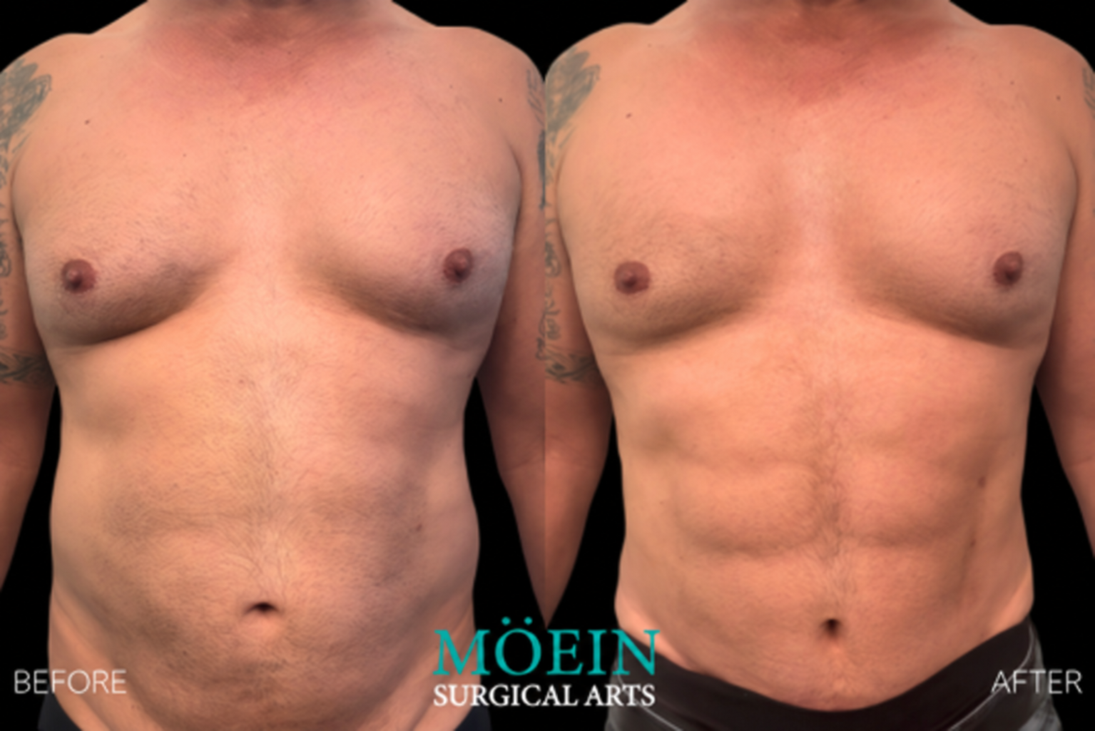 Moein Surgical Arts abdominal etching patient Before and after abdominal etching by Dr. Babak Moein.