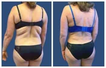 A woman in a bikini undergoing liposuction by an LA cosmetic surgeon, showcasing her incredible before and after transformation.