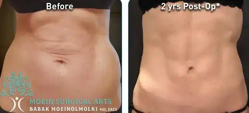 Before and After Renuvion Treatment at MSA in LA, CA