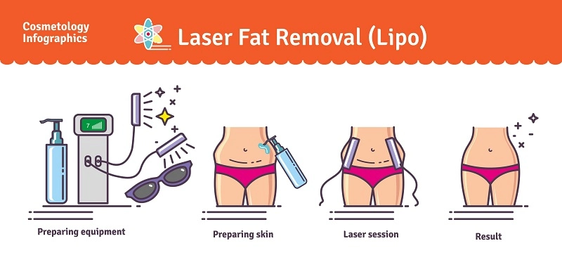 Benefits Of Laser Liposuction in LA
