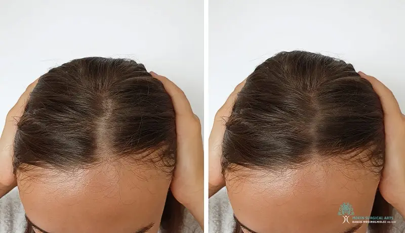 Benefits of Exosome Hair Treatment in LA Benefits of Exosome Hair Treatment in LA