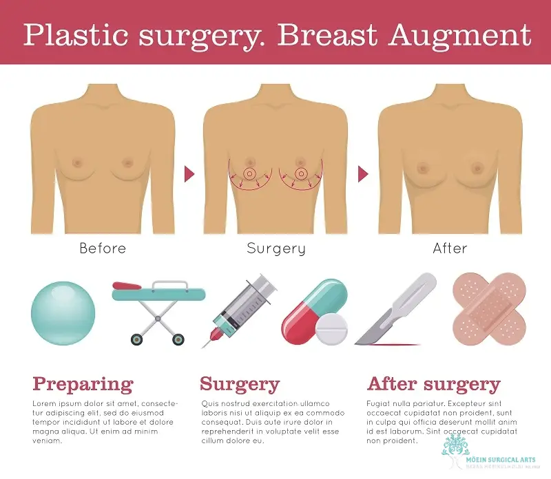 Breast Augmentation