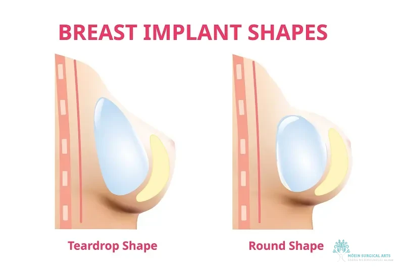 Breast Implant Removal and Lift in Los Angeles, CA