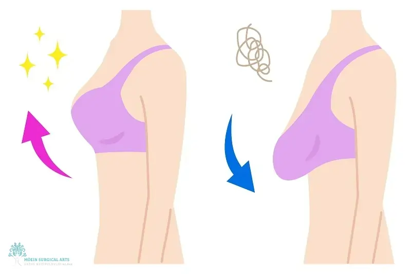 Breast Lift Surgery (Mastopexy) in Moein Surgical Arts Center LA, CA