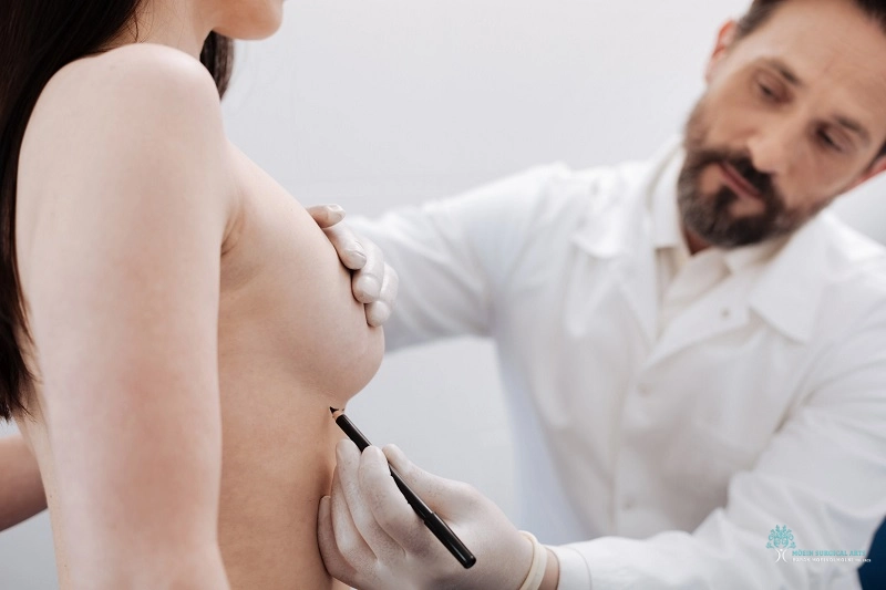Breast Lift Surgery in Los Angeles