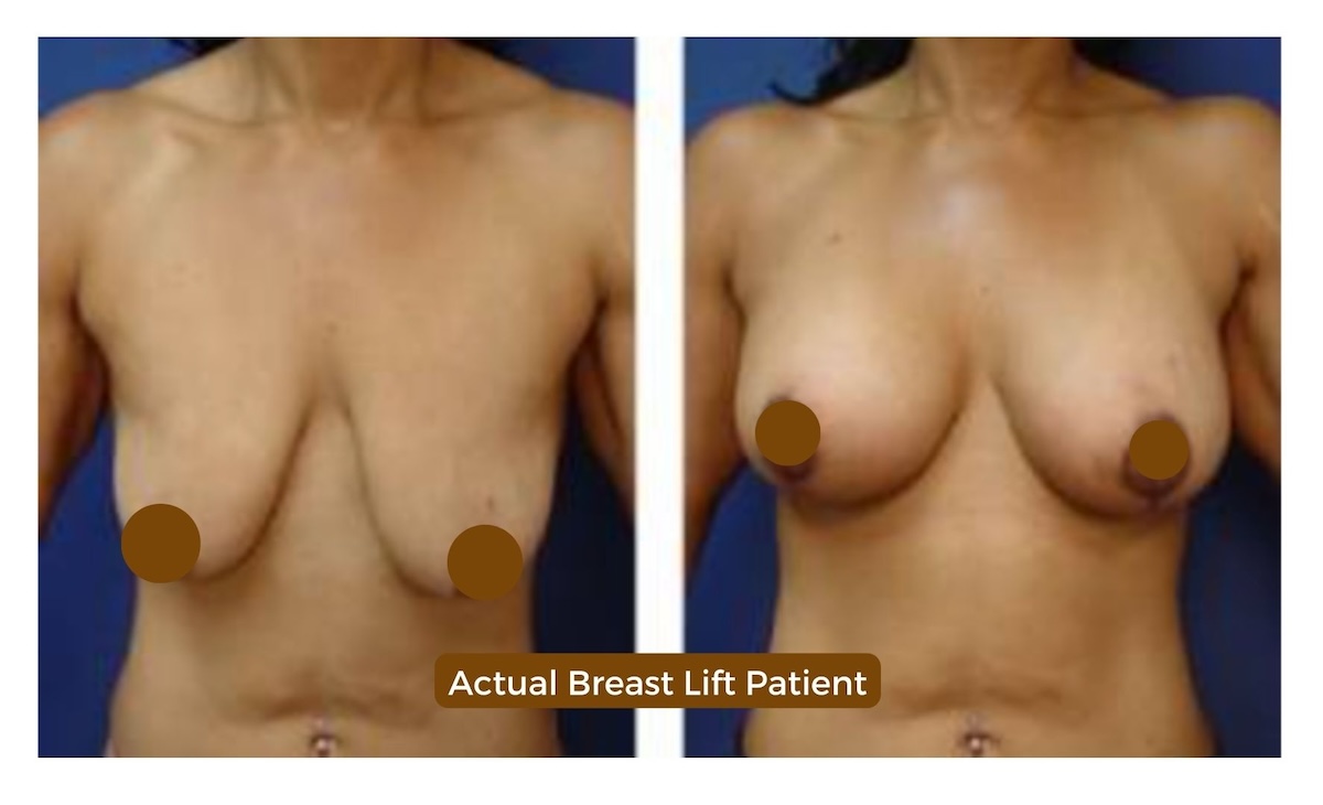 breast lift cosmetic rejuvenation