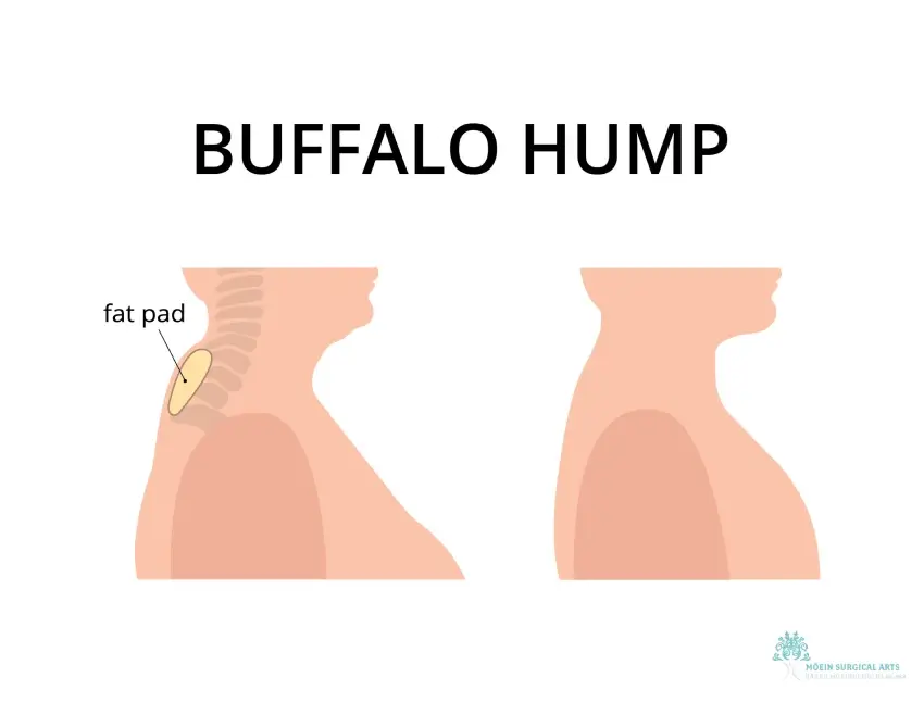 Buffalo Hump Removal Los Angeles, CA Buffalo Hump Removal in Los Angeles, CA