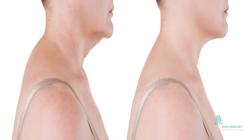 Buffalo Hump Removal Procedure LA Buffalo Hump Removal Procedure LA