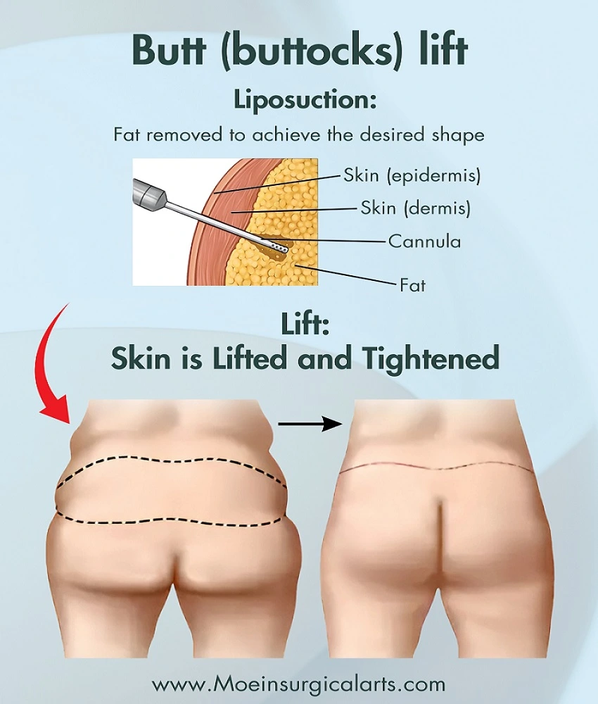 Butt Lift Los Angeles, CA Best Butt Lift service in Los Angeles, CA