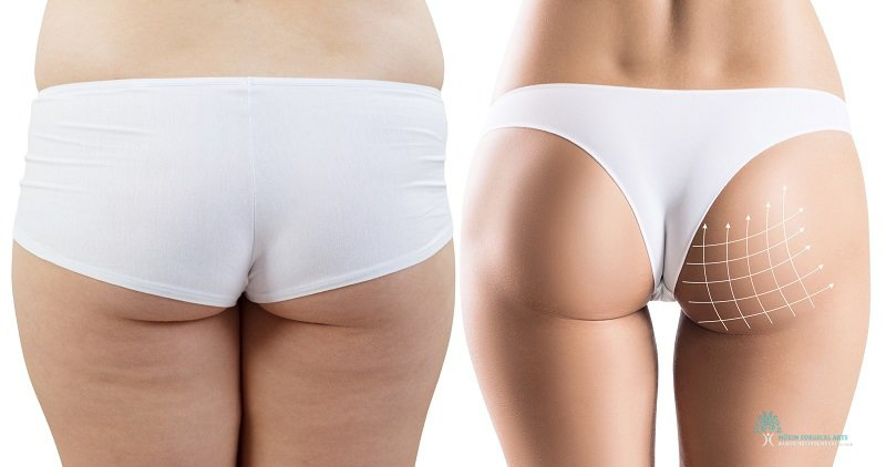 Butt Lift vs BBL Body Type Considerations