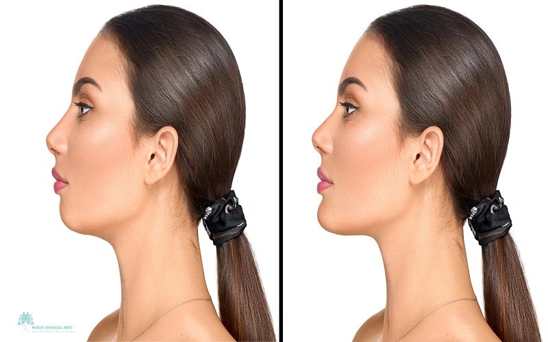 CHIN AUGMENTATION WITH FAT GRAFTING