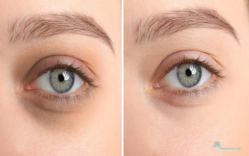 Dark Circle Removal in Los Angeles Dark Circle Removal in Los Angeles by Dr. Moein