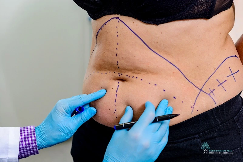 Day 1 of Tummy Tuck Surgery in LA