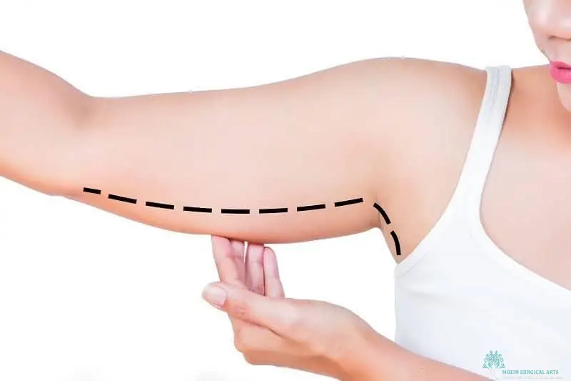 Definition of Extended Brachioplasty Los Angeles, CA