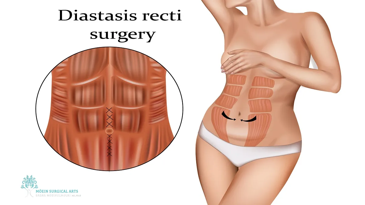 Diastasis Recti Surgery Options in Los Angeles