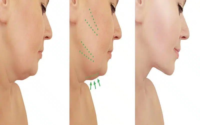 Role of aging in double chin development