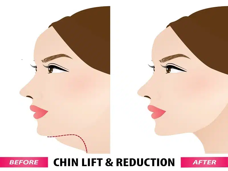 Effectiveness of Double Chins treatments