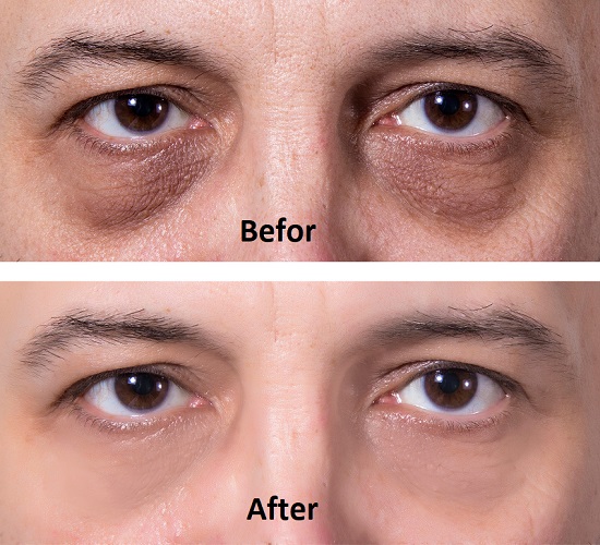 How to get rid of under-eye bags permanently without surgery?
