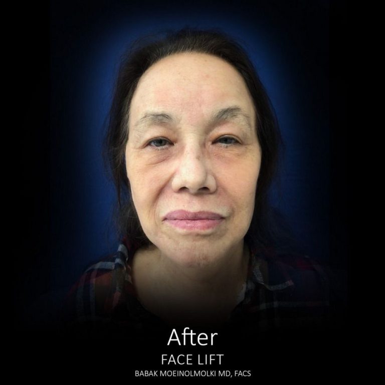 Face Lift Before and After