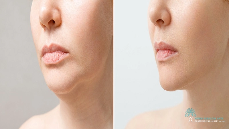 Final Results of Neck Lift in Los Angeles by Dr. Moein