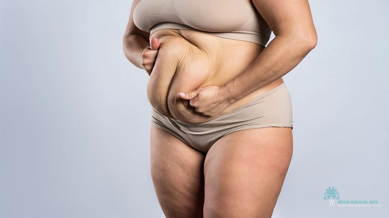 Fleur-De-Lis Tummy Tuck in Los Angeles