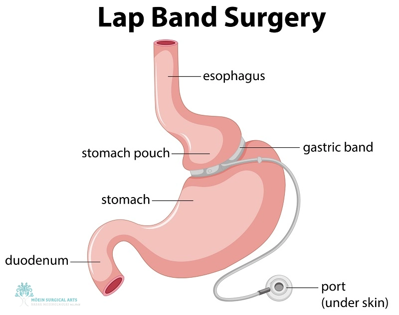 Gastric Banding in LA by Dr. Moein