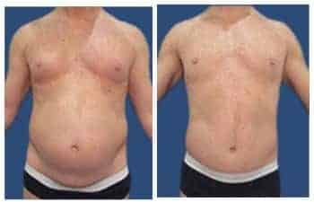 LA Cosmetic Surgeon specializing in tummy tuck procedures, showcasing impressive before and after transformations.