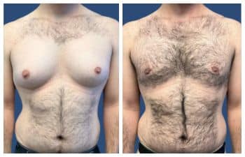 LA cosmetic surgeon's impressive before and after tummy tuck transformations.