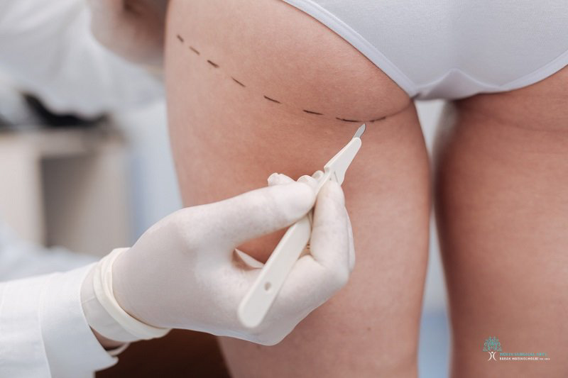 Healing Process After Butt Surgery in Los Angeles