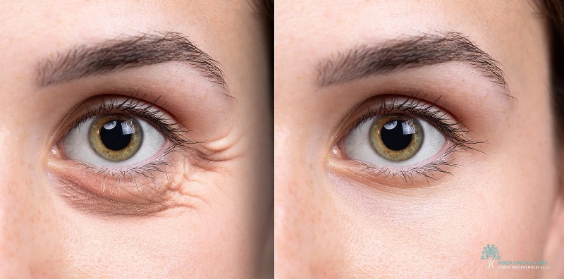 How to Choose the Right Eyelid (Blepharoplasty) Surgeon in Los Angeles