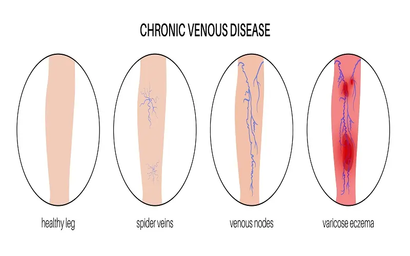 How to Get rid of Spider Veins LA, CA