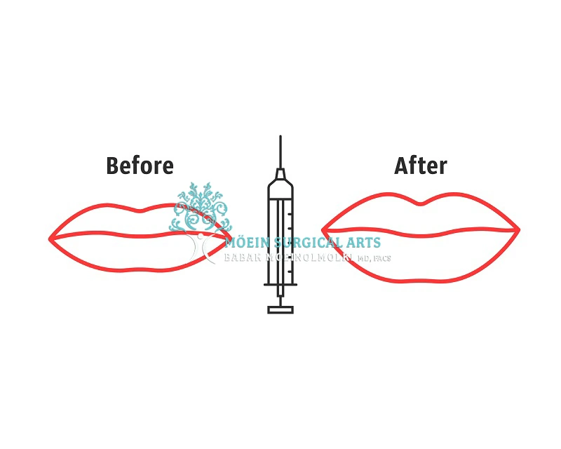 Ideal Candidates for Russian Lip Filler