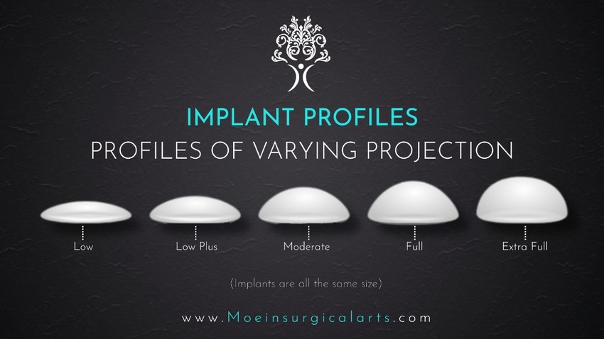 Implant Profiles Implant Profiles