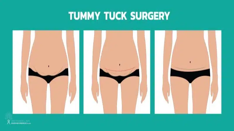 Healing from initial TUMMY TUCK Surgery