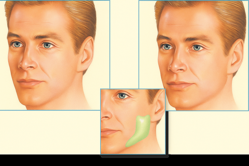 Jaw Implants in Los Angeles Jaw Implants in Los Angeles