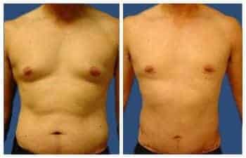 LA Cosmetic Surgeon specializing in tummy tuck procedures, showcasing impressive before and after results.