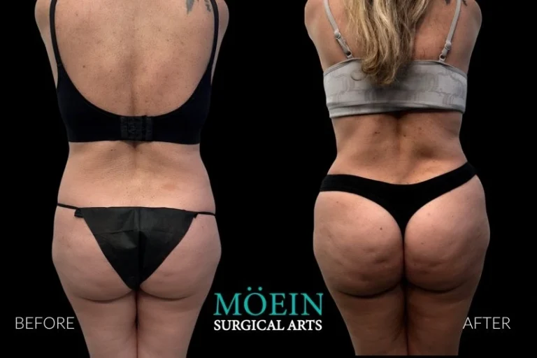 Lipo 360 Before After in LA CA 768x512 1